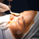 Phẫu Thuật Nâng Mũi