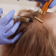 PRP Hair Treatment